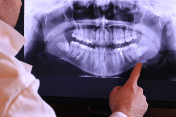 Best Emergency Wisdom Teeth Removal in Snowflake, AZ